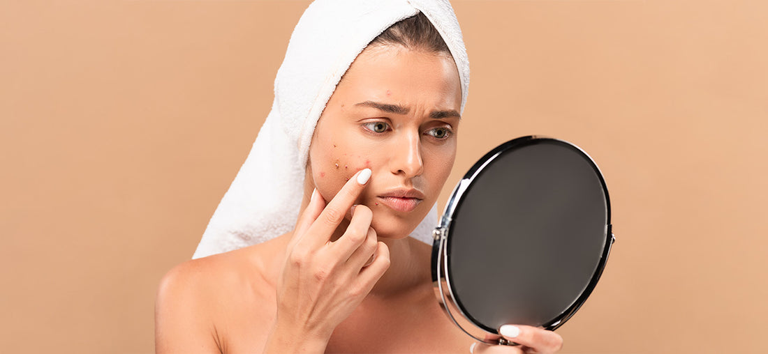 A women checking her faceacne and acnescars in the mirror | How to reduce acne